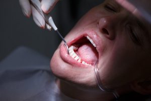 deep cleaning of teeth side effects