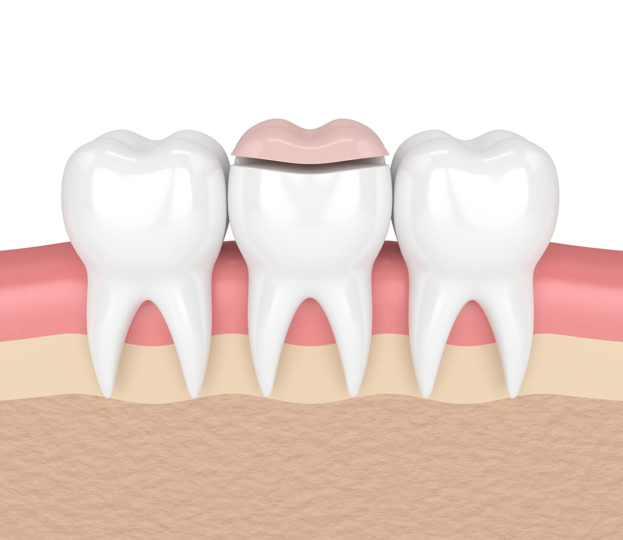 dental overlay