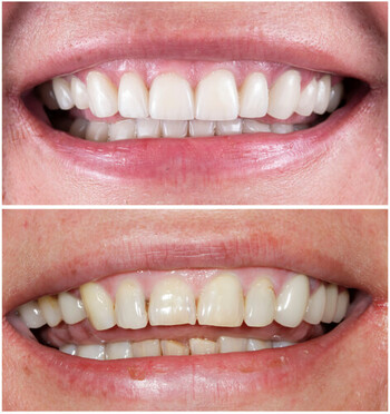 fluorosis in adults whitening