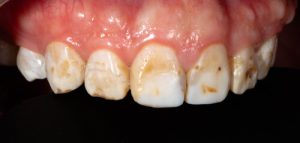 enamel hypoplasia vs fluorosis problem