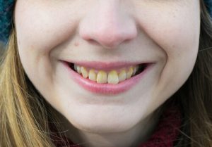 enamel hypoplasia vs fluorosis symptoms