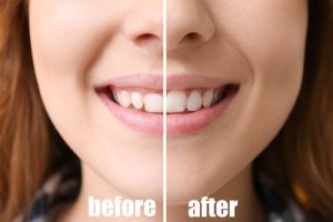 periodontal disease treatment